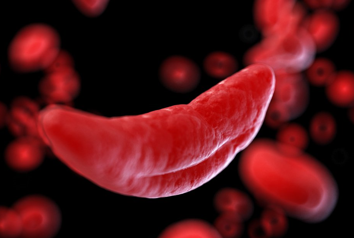 یک درمان احتمالی برای کم خونی داسی شکل